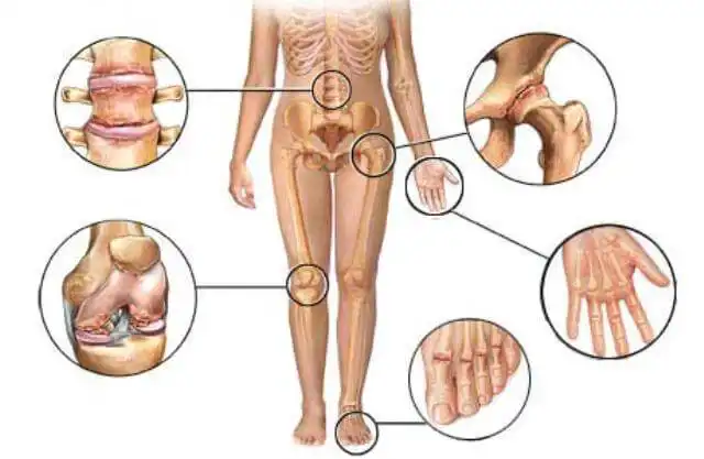 Artriti e artrosi- come fare diagnosi