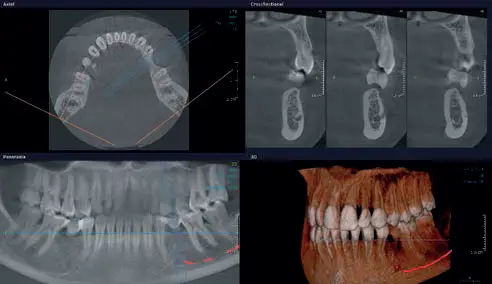 Come bean nella progettazione del tuo sorriso