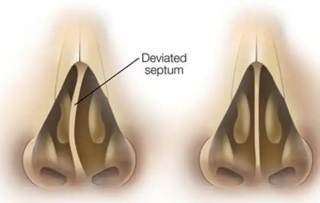 Deviazione del setto nasale possibile causa di sinusite e mal di testa