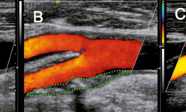 EcocolorDoppler dei tronchi sovraortici (TSA)- esame di prevenzione per il rischio cardiovascolare