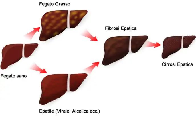 Epatite virale malattia da non sottovalutare