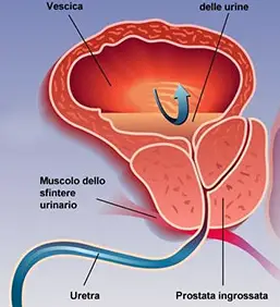 Iperplasia o ipertrofia prostatica benigna (IPB)