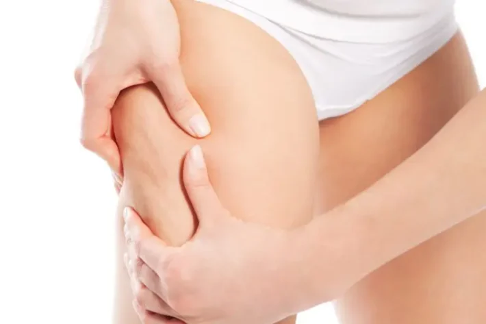 Onde urto cellulite