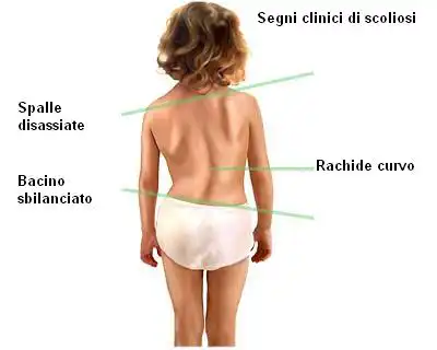 Scoliosi come riconoscerla in tempo