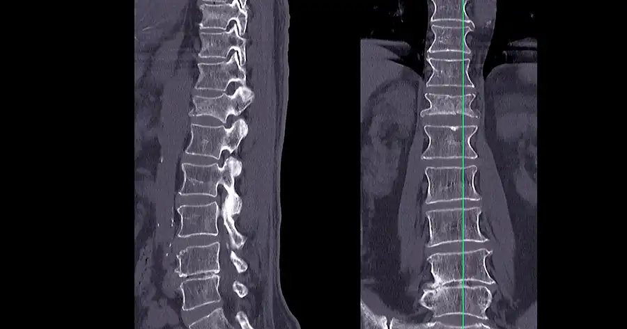 tc colonna con protocollo my spine scafati centro diagnostico san pietro